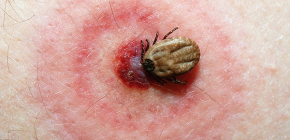 Carrapatos Borreliose e as consequências de suas picadas