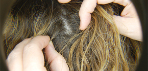 Comment traiter correctement les poux et les lentes