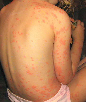 Numerous bed bug bites