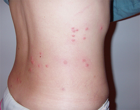 Bed bug bites