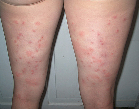 Bedbug bites on a woman's legs