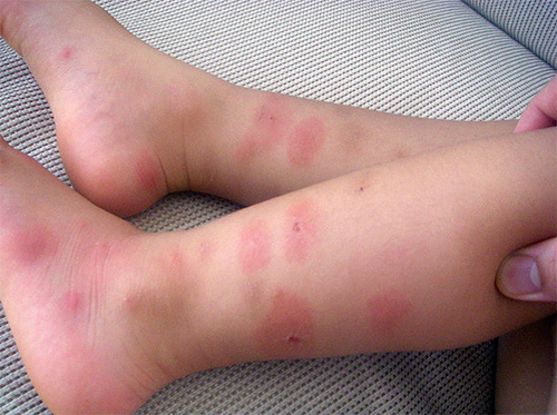 Les punaises de lit piquent les pieds de bébé