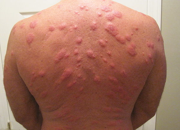Spesso si sviluppa una grave reazione allergica ai morsi di insetti domestici e la temperatura corporea può aumentare.