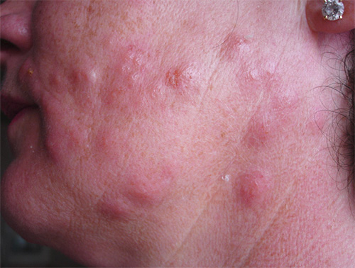 Bedbug bites on the face