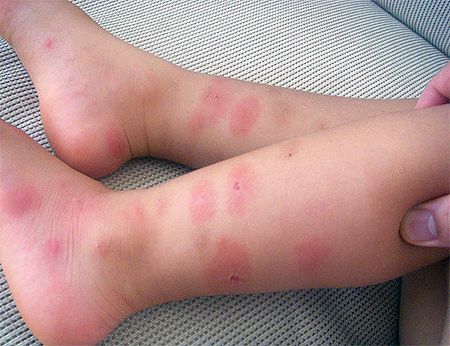 Bed bug bites on child's legs