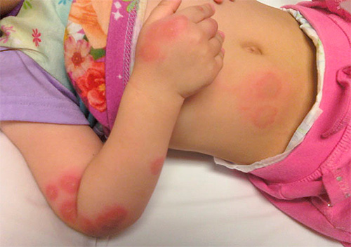 Allergic reaction in a child to bedbug bites