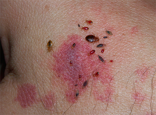 Bed bugs and their larvae on human skin
