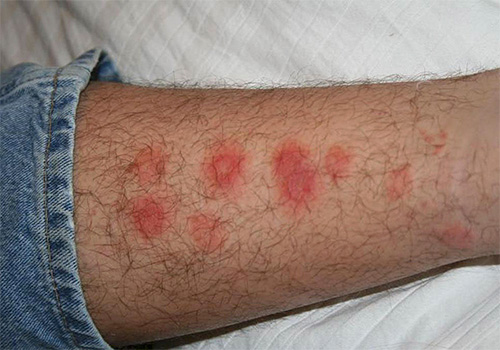 Characteristic path of bedbug bites