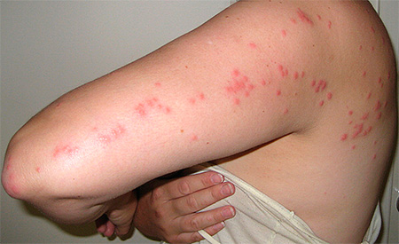 Numerous bed bug bites