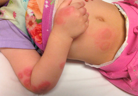 Un esempio di reazione allergica moderatamente grave alle punture di cimici