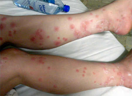 Numerose punture di cimici sulle gambe del bambino