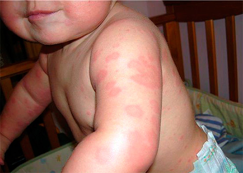 Un esempio di allergia in un bambino alle punture di cimici