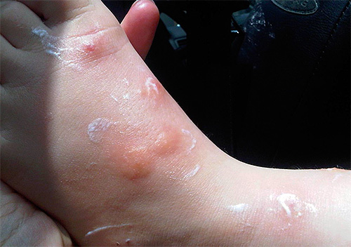 Il gel di solito può essere applicato su ferite da morso piangenti.