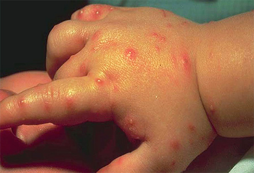 La formica punge sulla mano di un bambino