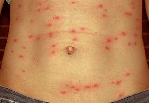 Les poux sont porteurs du typhus, dont l'un des symptômes est une éruption cutanée sur le corps.