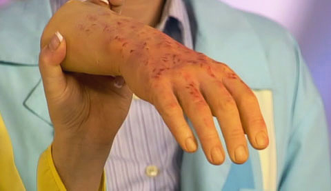 Signes de typhus sur la peau de la main