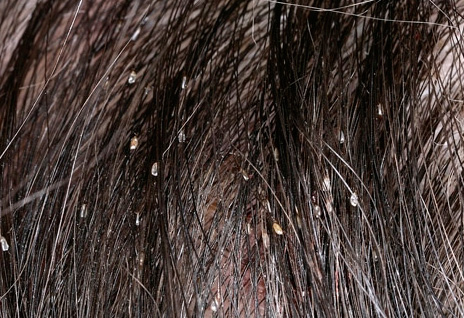 As a rule, nits on the hair are not the main infecting agents.