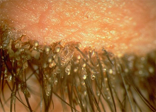 Un'altra foto con lendini sulle ciglia