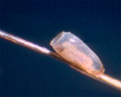 Lendini vuote lasciate sui capelli dopo che le larve del pidocchio sono uscite