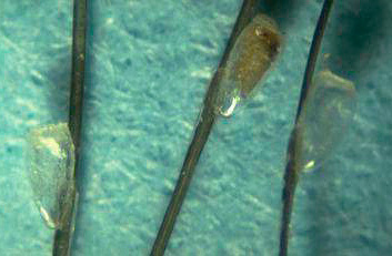 Lendini sui capelli (foto in primo piano)