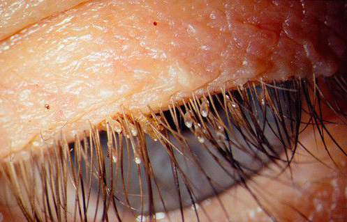 Les poux et leurs lentes sur les cils