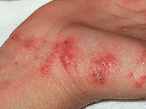 L'acaro della scabbia provoca lo stesso forte prurito della pelle dei pidocchi