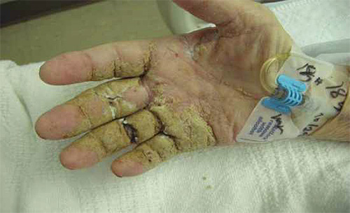 Mano di una persona con segni di scabbia norvegese