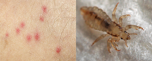 The bites of linen lice differ markedly from the bites of other insects. How to recognize them - we will learn further.