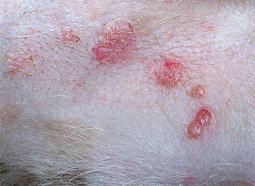 Pyoderma (purulent skin lesions) caused by bed lice bites