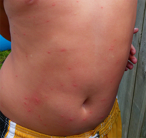 Linen lice infect areas of the body that are hidden by clothing, unlike, for example, mosquitoes