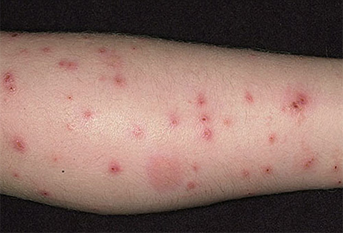 Flea bites on leg