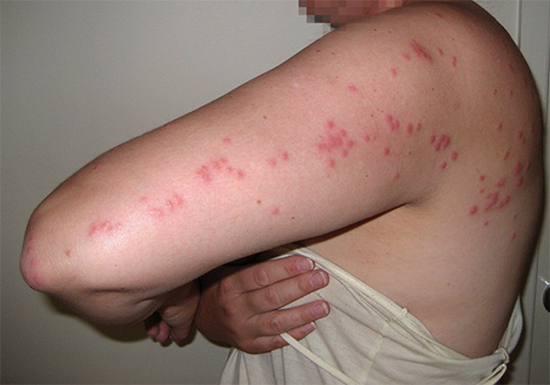 Bed bug bites are usually located on the body in the form of a path.