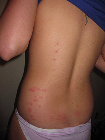 Linen lice bites on the back