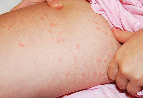 Linen lice bites in the thigh area