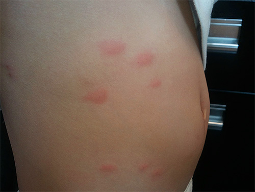 Redness on the skin in places of lice bites