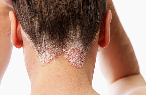 Les symptômes de la maladie cutanée du psoriasis peuvent bien se manifester dans le contexte d'expériences fortes.
