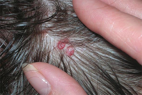 Löss hos ett barn är också farligt eftersom purulent inflammation ibland bildas på platserna för kammade bett.