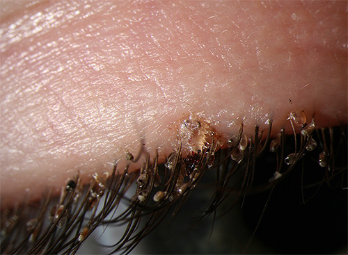 Piolhos púbicos e suas lêndeas em cílios humanos