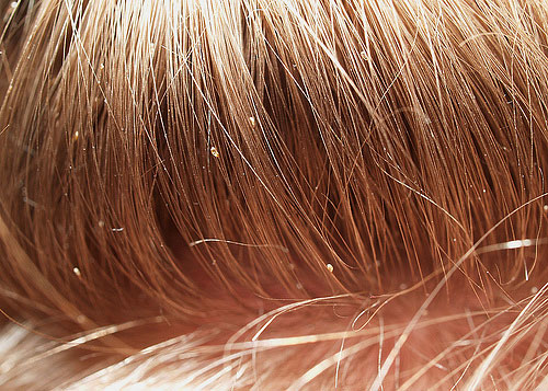 Anche le lendini morte conferiscono ai capelli un aspetto molto sgradevole.