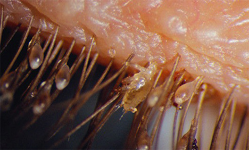 Pubic lice สามารถอยู่บนขนตาและคิ้วได้