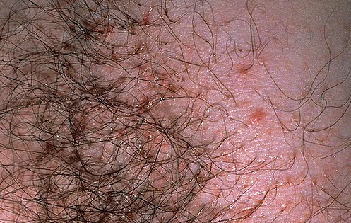 และนี่คือสิ่งที่ pubic lice กัดดูเหมือนกับการติดเชื้อปรสิตเล็กน้อย