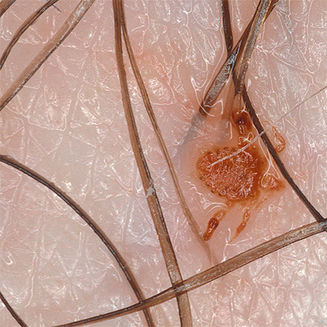 อีกชื่อสามัญสำหรับ pubic lice คือเหา