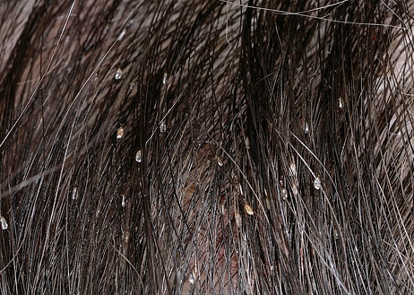 Nits on the hair in life look unpleasant, but in a dream they can promise favorable events.
