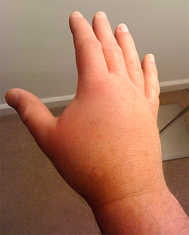 When biting a hornet, you do not need to look for a sting under the skin, but you need to immediately treat the wound.