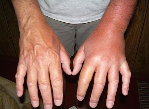 In the photo - a hand swollen after a hornet bite