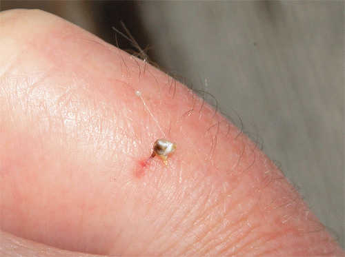 Bee sting left in human skin