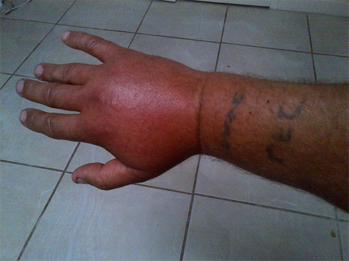 Hornet stings can cause very severe tissue swelling.