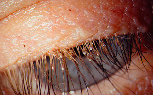 Les poux du pubis peuvent infecter les cils et les sourcils d'une personne.