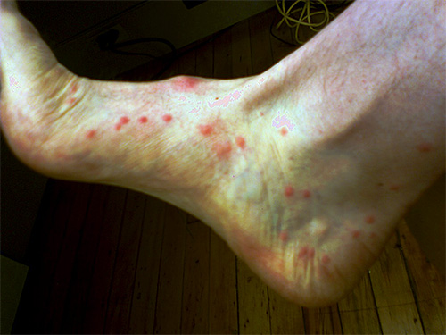 When bitten, a flea injects secretions of special glands under the skin, which cause a primary allergic reaction.