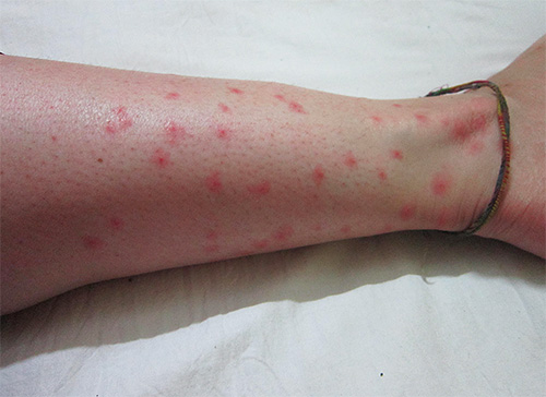 Flea bites can cause not only an allergic reaction, but also very serious diseases.